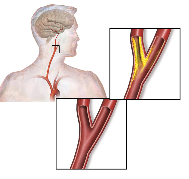 File:Carotid artery stenosis.png