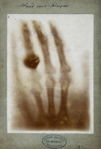 File:First medical X-ray by Wilhelm Röntgen of his wife Anna Bertha Ludwig's hand - 18951222.jpg