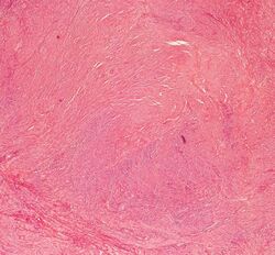 Histopathology of uterine leiomyoma.jpg