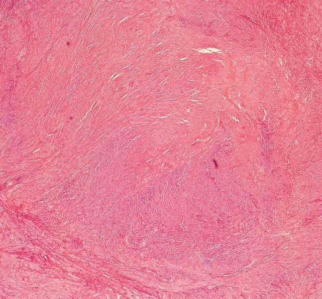 File:Histopathology of uterine leiomyoma.jpg