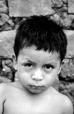 Black and white photo of a young boy with a swollen right eye