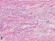 Histopathology of granulation tissue with formation of microvessels in myocardial infarction.jpg