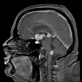 Primary central nervous system B-cell non-Hodgkin lymphoma.jpg