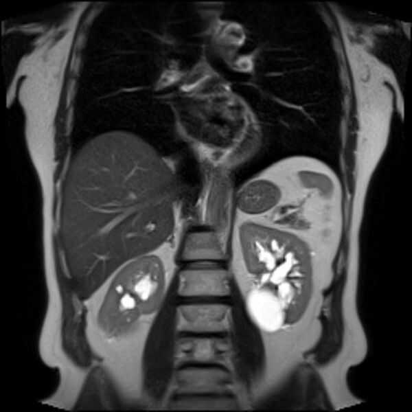File:Renal cyst MRI.jpg