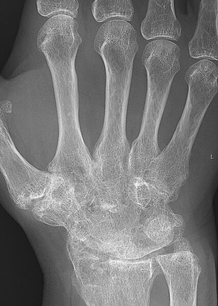 File:Rheumatoid arthritis with carpal ankylosis 2017.jpg