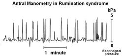 Rumination manometry.jpg