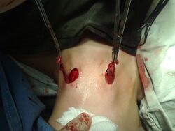 Bilateral Branchial Cleft Sinus intraoperative.jpg