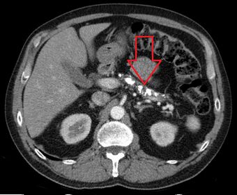 Chronische Pankreatitis mit Verkalkungen - CT axial.jpg