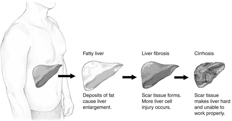 File:Stage of liver damage high.jpg