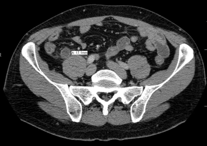 File:CAT scan demonstrating acute appendicitis.jpg