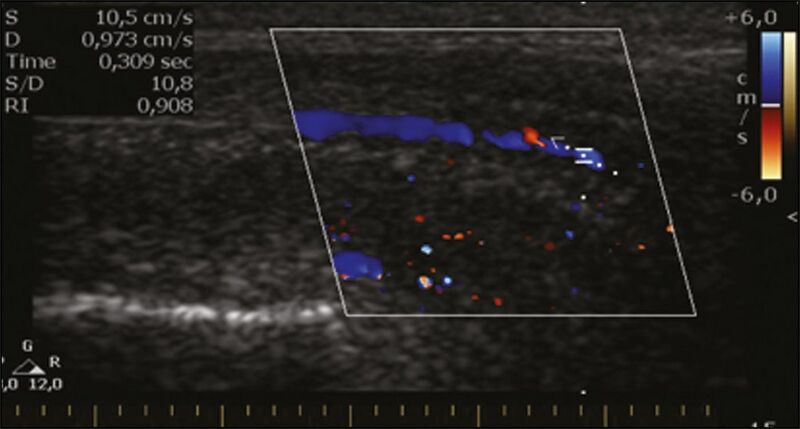File:Longitudinal doppler ultrasonography of the penis.jpg