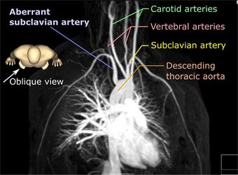 Arteria lusoria MRA MIP-03 - Annotated.jpg