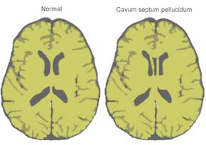 CavumSeptumPellucidumDiagram.jpg