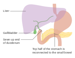 Diagram showing the anatomy after a partial gastrectomy (Bilroth 02) CRUK 281.svg