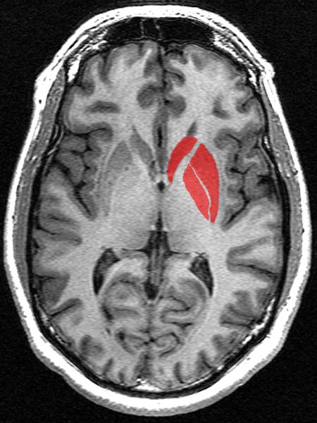 File:Striatum Structural MRI.png