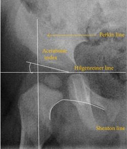 X-ray of measurements on a normal hip.jpg