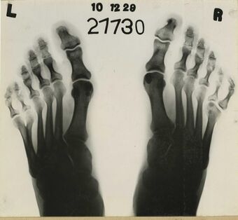 X-ray of polydactyl feet (Reeve 48693), National Museum of Health and Medicine (3298021231).jpg
