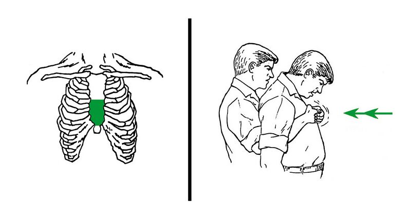 File:Chest thrusts against choking.jpg