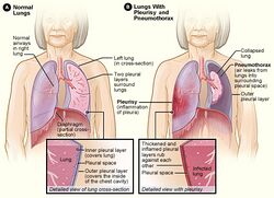 Pleurisy and pneumothorax.jpg