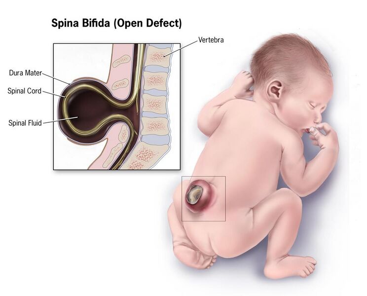 File:Spina-bifida.jpg