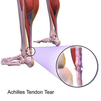 Achilles Tendon Tear.png