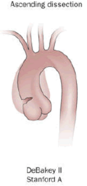 File:Aortic dissection of DeBakey type II.png