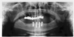 Implant supported overdenture.jpg