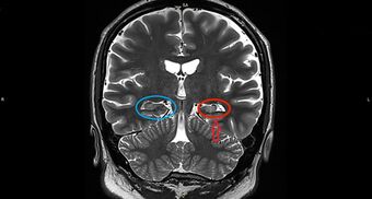 Left Hippocampal Sclerosis on MRI.jpg