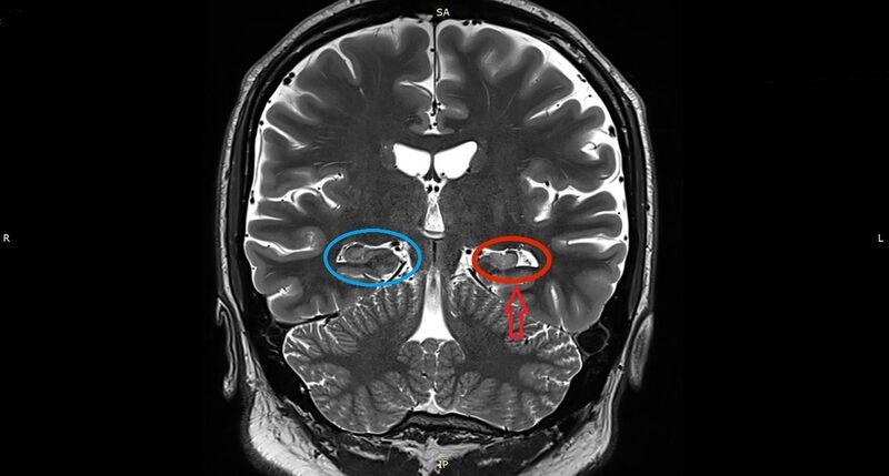 File:Left Hippocampal Sclerosis on MRI.jpg
