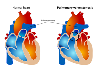 Pulmonary valve stenosis.svg