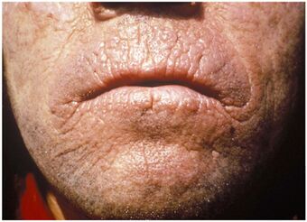 Chronic skin lesions of EPP.jpg