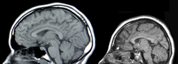 Side by side image of patient with average sized brain, and patient with smaller brain due to microcephaly.