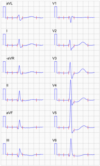 Signal-averaged ECG with digoxin.png