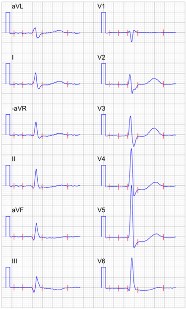 Chemistry:Digoxin - HandWiki