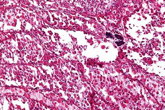 Alveolar soft part sarcoma - intermed mag.jpg
