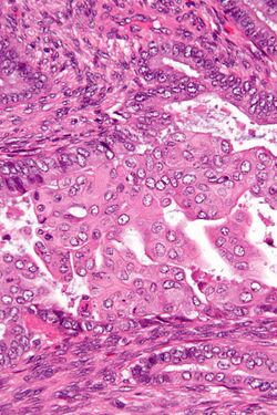 Atypical polypoid adenomyoma - very high mag.jpg