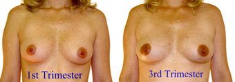 Breast changes during pregnancy 1.png