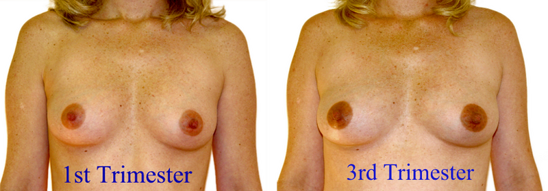 File:Breast changes during pregnancy 1.png
