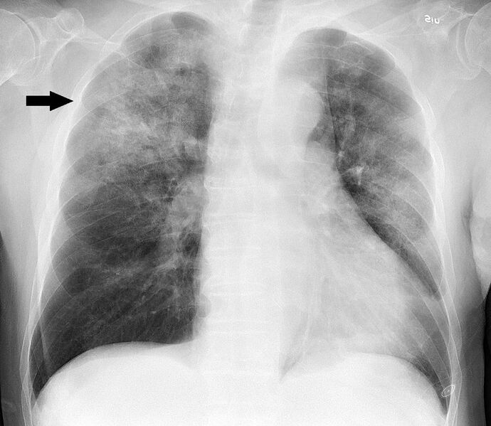 File:Chest radiograph in influensa and H influenzae, posteroanterior, annotated.jpg