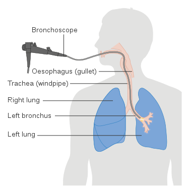 File:Diagram showing a bronchoscopy CRUK 053.svg