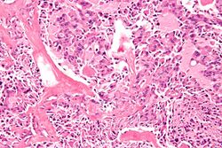 Medullary thyroid carcinoma - 2 - high mag.jpg