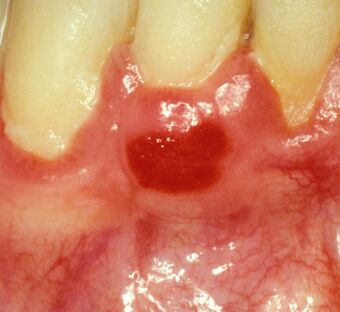 Plasma cell gingivitis in adult.jpg