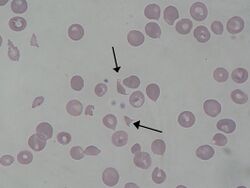 Schizocyte smear 2009-12-22.JPG