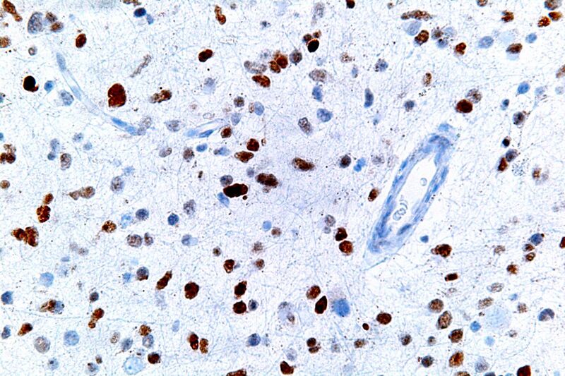 File:Anaplastic astrocytoma - p53 - very high mag.jpg