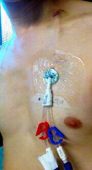 Photograph of an inserted Hickman line, which is a type of tunneled catheter, inserted in the chest.