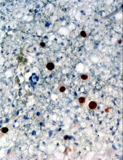 Immunohistochemical detection of "Human polyomavirus 2" protein (stained brown) in a brain biopsy (glia demonstrating progressive multifocal leukoencephalopathy (PML))