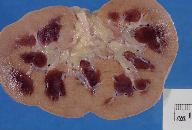File:Kidney – acute cortical necrosis.jpg