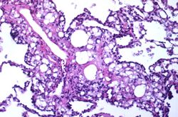 Lipid pneumonia, exogenous (3791887936).jpg