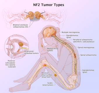 Neurofibromatosis type II tumor types.png