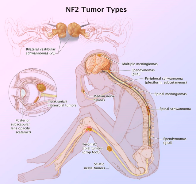 File:Neurofibromatosis type II tumor types.png